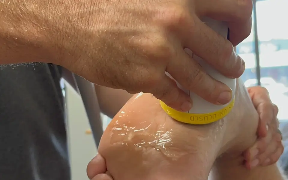 SoftWave applicator treating the heel and arch of a foot